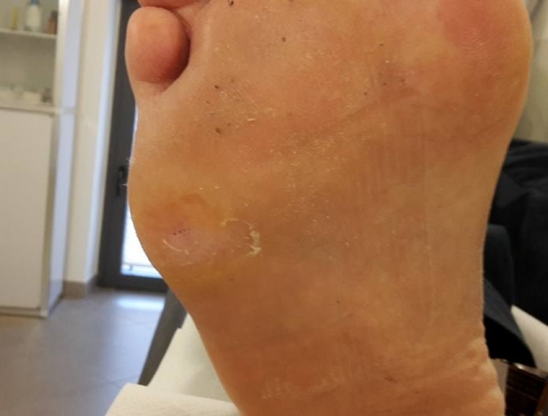 Ulcera diabetica (caso clinico)